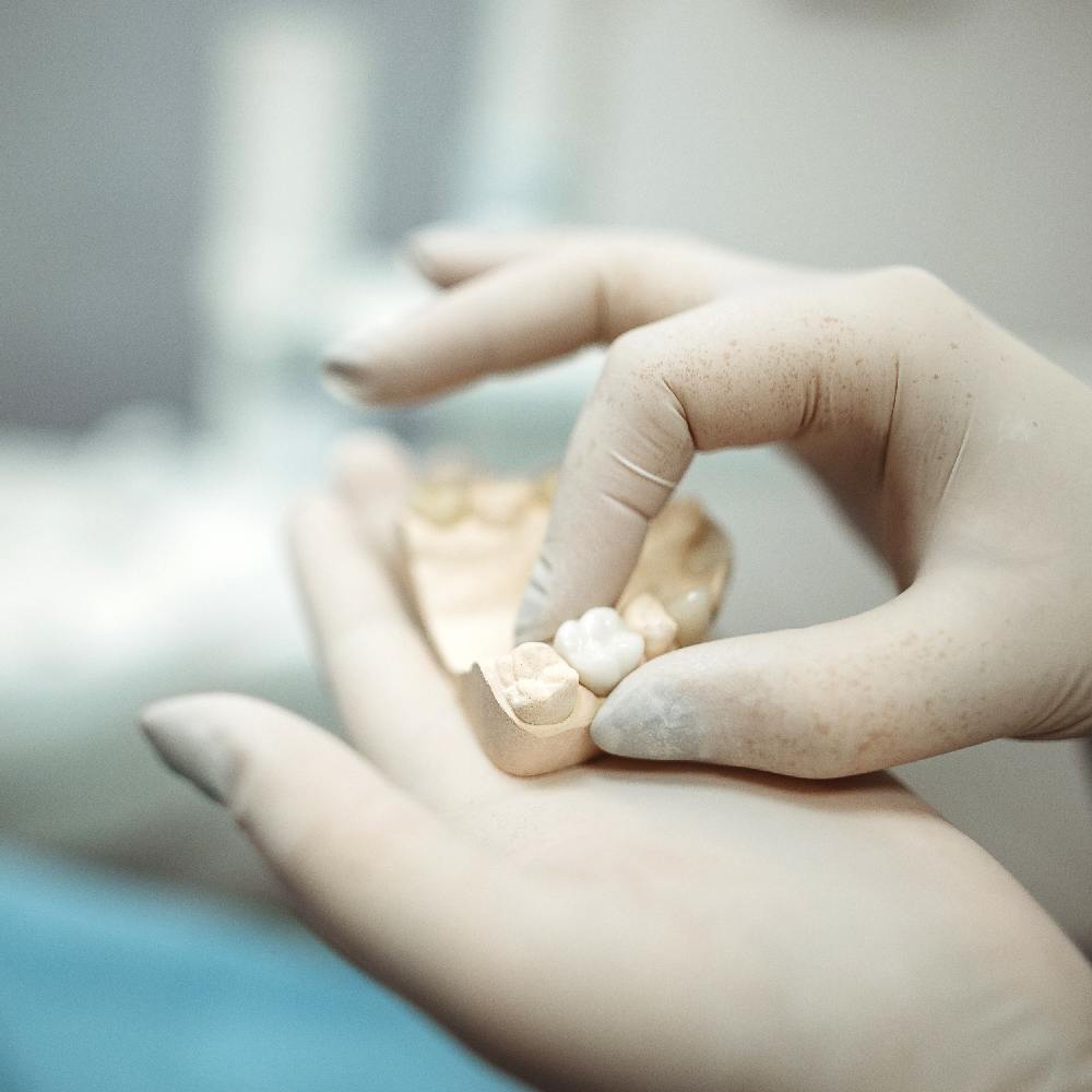 l'implant dentaire pour une meilleure santé buccale